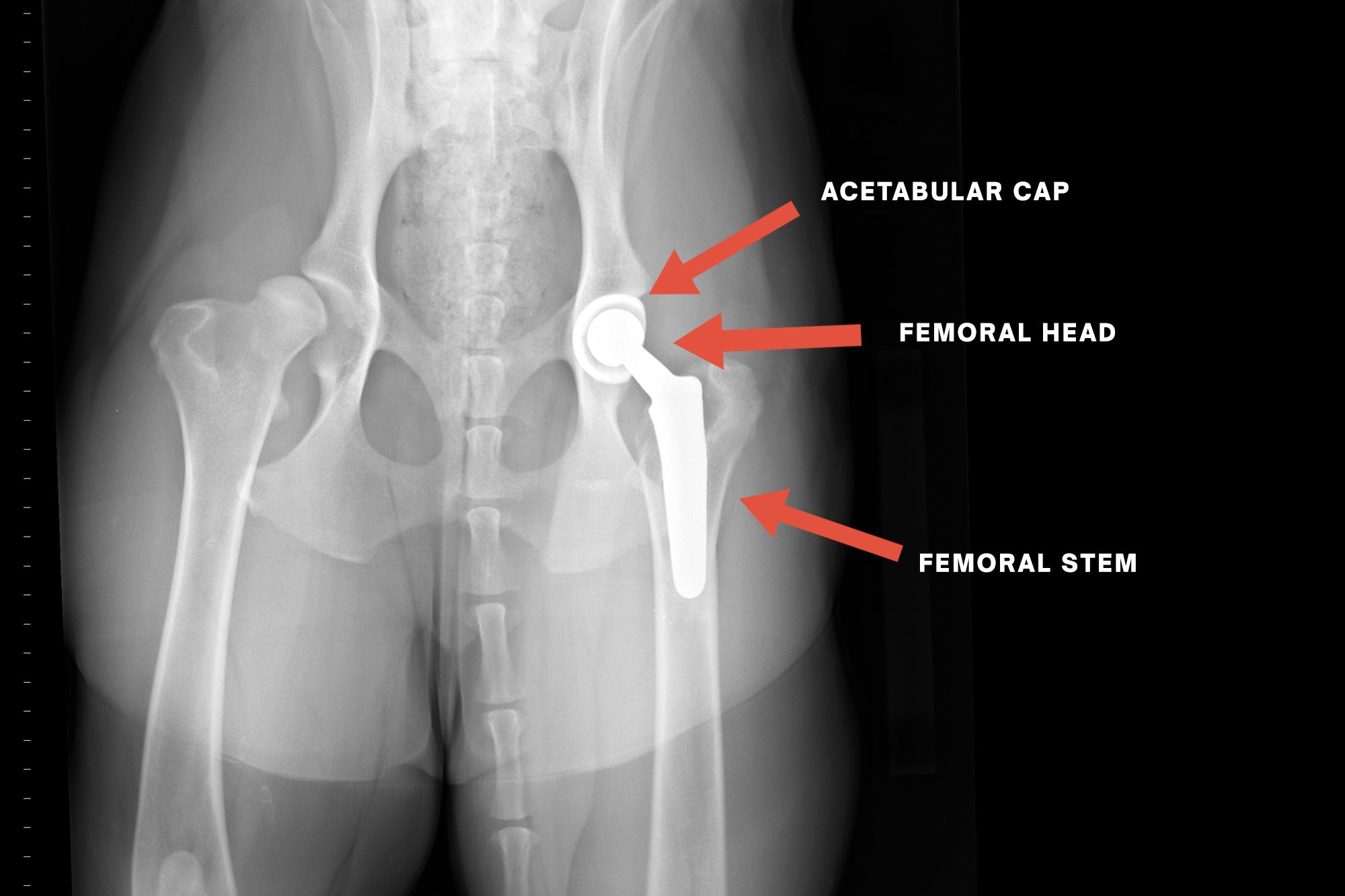 Hip-After-Bio