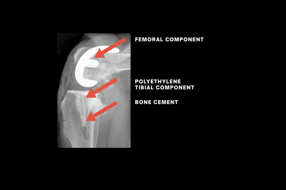 Radiograph--Knee-After